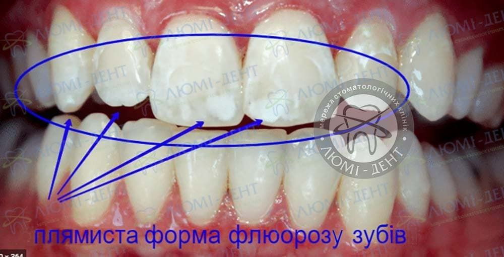 Муаровый рисунок эмали при флюорозе обусловлен